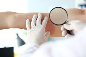 רופא בודק מחלת עור בזרוע של מטופל