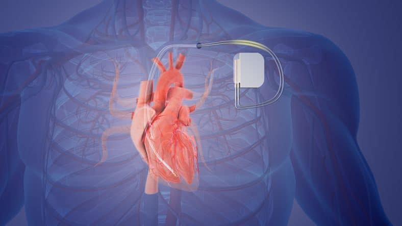 Permanent Pacemaker Implant Medical Concept