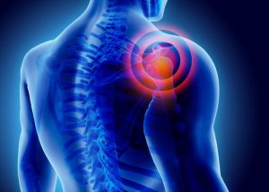 אילוסטרציה של כאבי שרירים בכתף