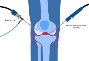 איור של הליך רפואי ארתרוסקופי. ניתוח זעיר פולשני במפרק הברך. ארתרוסקופיה של מפרק הברך