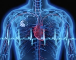 תמונת המחשה של בית החזה עם איור של לב וקוצב לב לידו