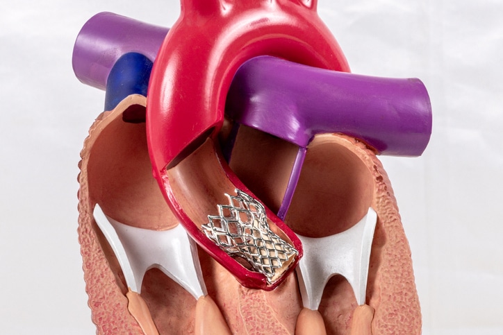 Cardiac Model Of Transcatheter Aortic Valve Implantation (TAVI) For People Education. Heart Transplant And Surgery Concept, Shunting. Plastic Human Heart Model Showing The Interior.