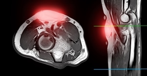 סריקת ה-MRI מגלה נגע ליפומה במפרק המרפק, המודגש על ידי האזור האדום