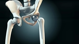 תמונת המחשה לשתל של מפרק בירך