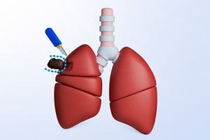 Segmentectomy Of The Lung